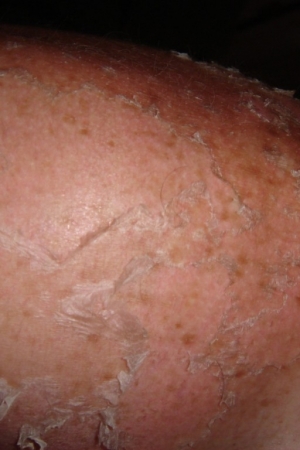 Pielęgnacja skóry trądzikowej – 5 zasad, których pewnie nie znasz…